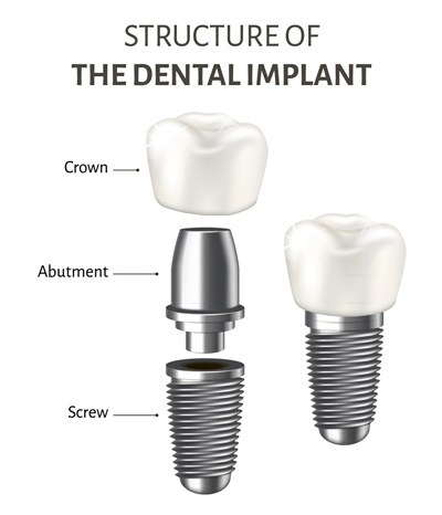 Dental Implant